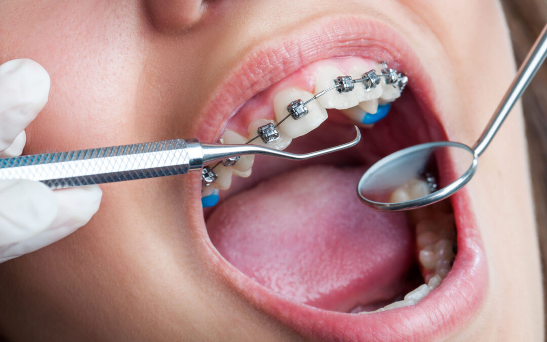 extreme macro close up of open human mouth showing stainless steel braces.